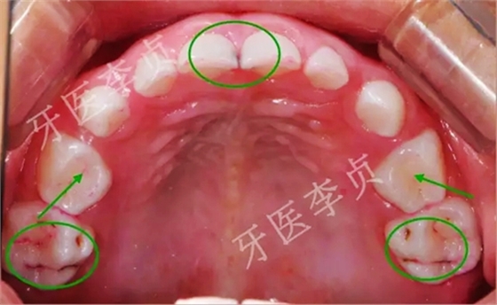 兒牙病例|兒童蛀牙的修復(fù)