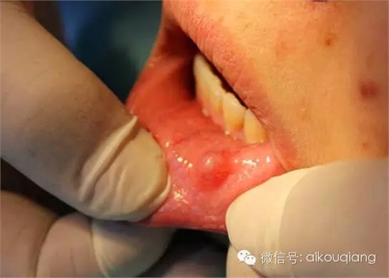 粘液腺囊腫 粘液腺囊腫