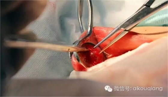 粘液腺囊腫 粘液腺囊腫