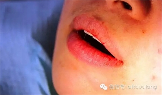 粘液腺囊腫 粘液腺囊腫