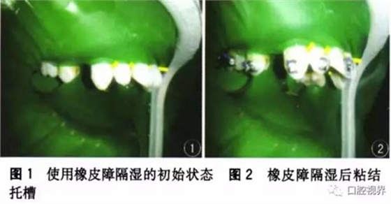橡皮障，是用還是不用？