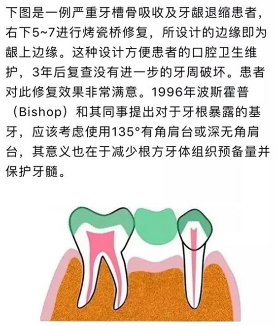 做全冠修復時基牙根面暴露，如何備牙？