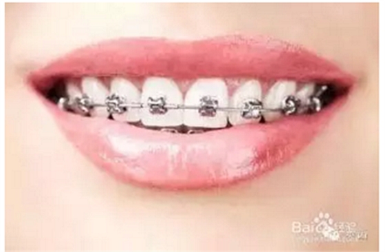 正畸流程(拔牙) 正畸流程(拔牙)