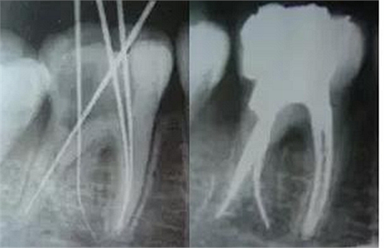 根管治療圖譜 根管治療圖譜