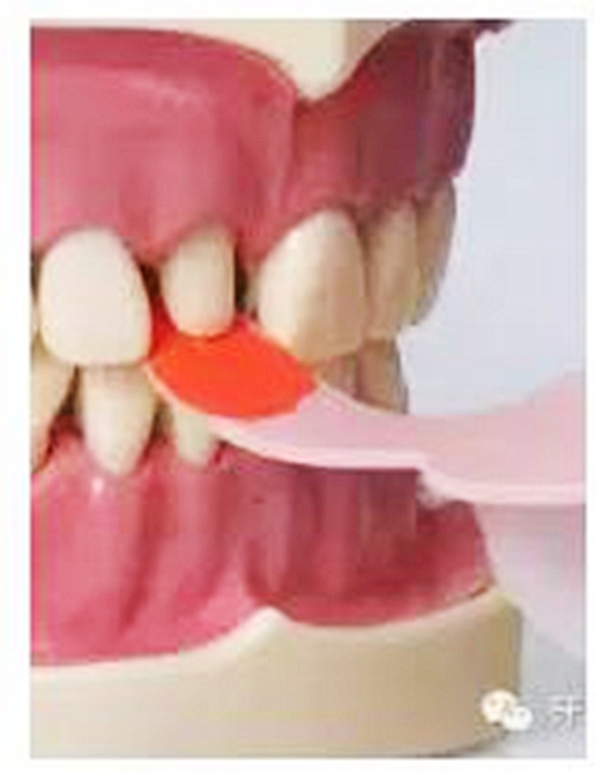 根管治療圖譜 根管治療圖譜