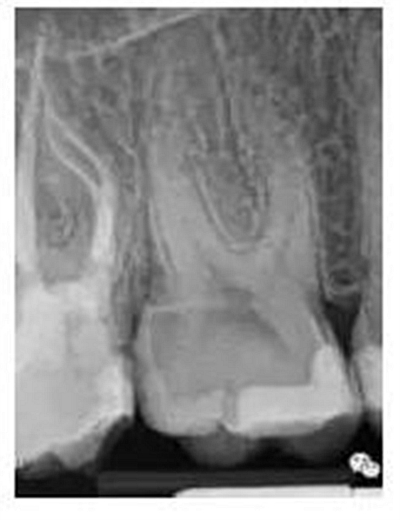 根管治療圖譜 根管治療圖譜