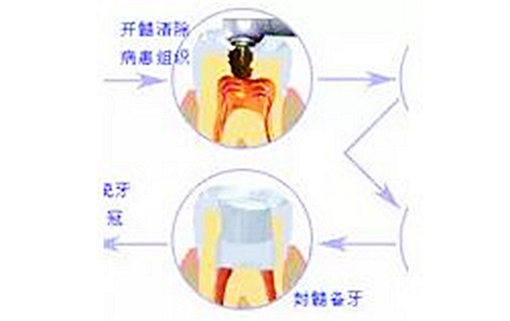 根管治療圖譜 根管治療圖譜