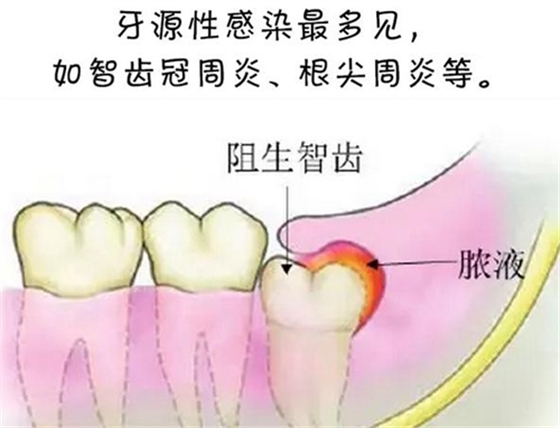 警惕！牙疼引發(fā)的間隙感染很危險