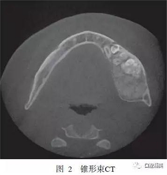 下頜骨骨化纖維瘤并發(fā)組合性牙瘤1例