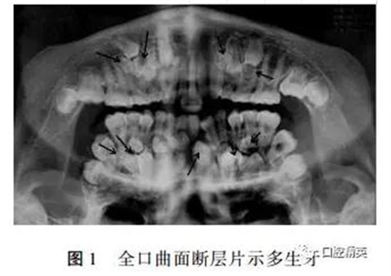 罕見多發(fā)性14顆多生牙1例