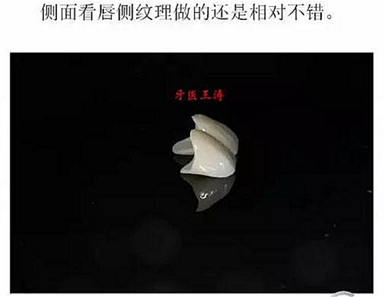 前牙外傷冠延長+全瓷冠修復(fù)