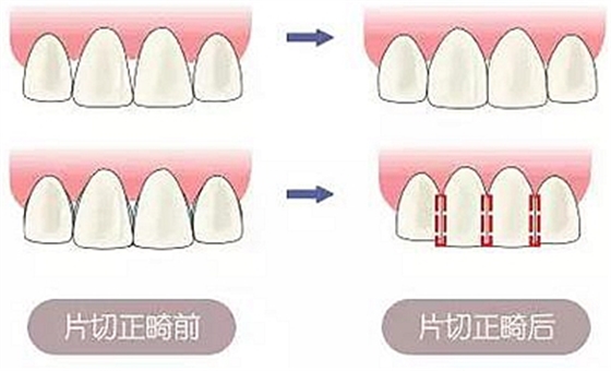 醫(yī)生方案里的鄰面去釉，究竟是什么？