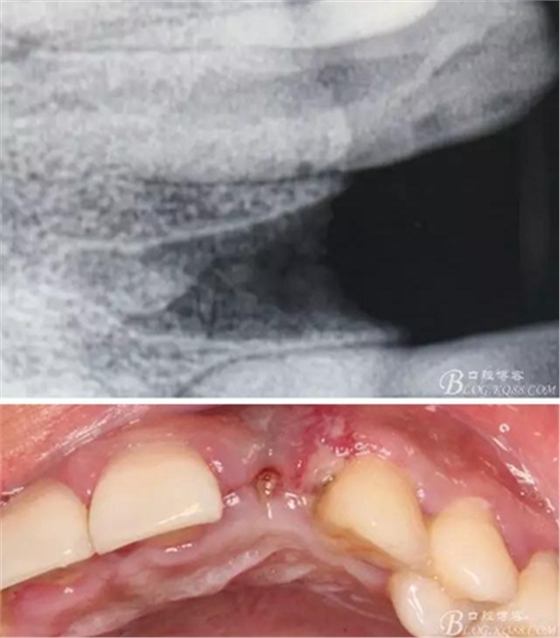 一例上前牙種植失敗病例的補救
