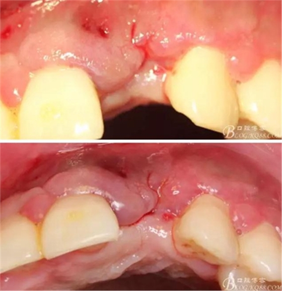 一例上前牙種植失敗病例的補救