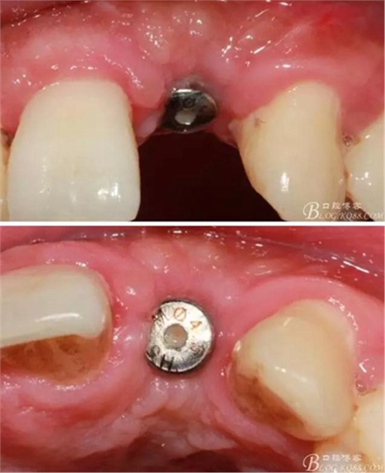 一例上前牙種植失敗病例的補救