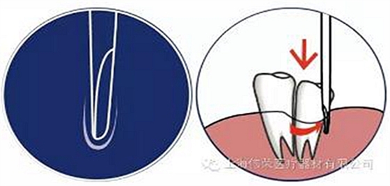 半/微創(chuàng)牙挺 半/微創(chuàng)牙挺