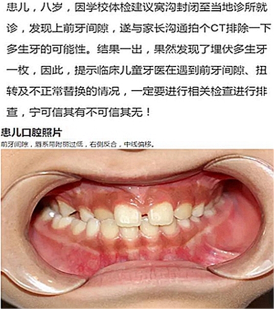 多生牙的拔除總原則：早發(fā)現(xiàn)，早處理！