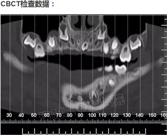 多生牙的拔除總原則：早發(fā)現(xiàn)，早處理！