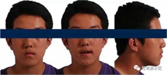 種植釘多維運用矯正高角反頜及開頜—對羅晨醫(yī)生專訪及病例展示(上) 種植釘多維運用矯正高角反頜及開頜—對羅晨醫(yī)生專訪及病例展示(上)