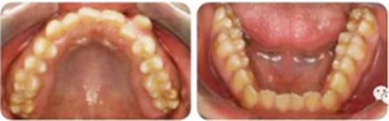 種植釘多維運用矯正高角反頜及開頜—對羅晨醫(yī)生專訪及病例展示(上) 種植釘多維運用矯正高角反頜及開頜—對羅晨醫(yī)生專訪及病例展示(上)
