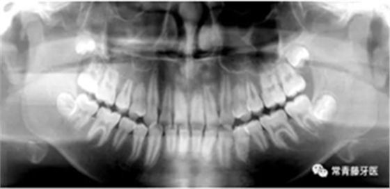 種植釘多維運用矯正高角反頜及開頜—對羅晨醫(yī)生專訪及病例展示(上) 種植釘多維運用矯正高角反頜及開頜—對羅晨醫(yī)生專訪及病例展示(上)