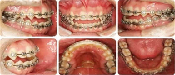 種植釘多維運用矯正高角反頜及開頜—對羅晨醫(yī)生專訪及病例展示(上) 種植釘多維運用矯正高角反頜及開頜—對羅晨醫(yī)生專訪及病例展示(上)