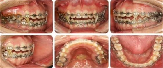 種植釘多維運用矯正高角反頜及開頜—對羅晨醫(yī)生專訪及病例展示(上) 種植釘多維運用矯正高角反頜及開頜—對羅晨醫(yī)生專訪及病例展示(上)