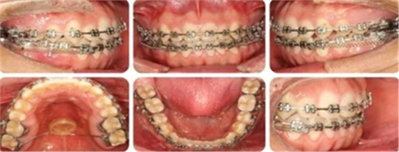種植釘多維運用矯正高角反頜及開頜—對羅晨醫(yī)生專訪及病例展示(上) 種植釘多維運用矯正高角反頜及開頜—對羅晨醫(yī)生專訪及病例展示(上)