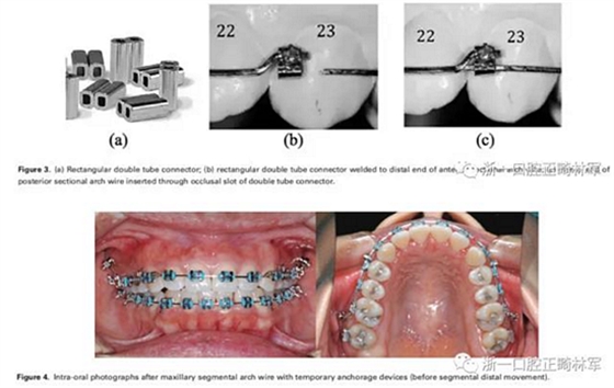 正畸文獻閱讀-兩種不同矯治力下上頜后牙段遠移的生化與臨床比較