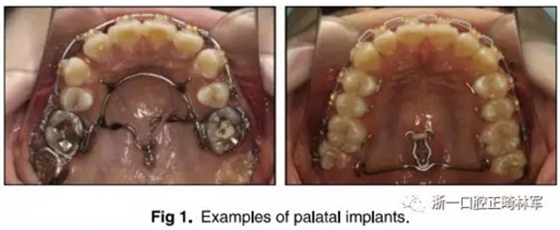 正畸文獻(xiàn)閱讀--上頜支抗初次植入失敗后二次植入穩(wěn)定性的研究 正畸文獻(xiàn)閱讀--上頜支抗初次植入失敗后二次植入穩(wěn)定性的研究