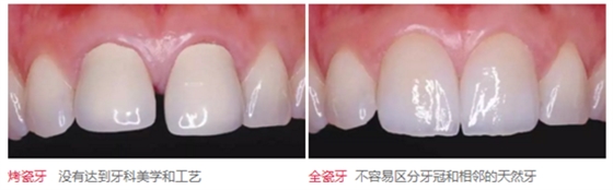 醫(yī)生，我的烤瓷牙上有個黑線怎么回事？