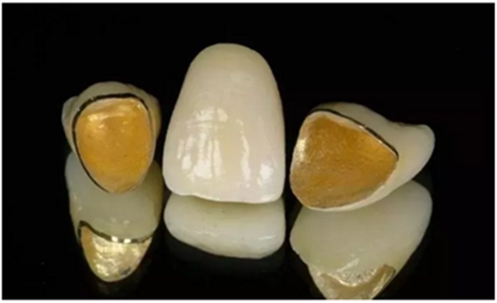 醫(yī)生，我的烤瓷牙上有個黑線怎么回事？