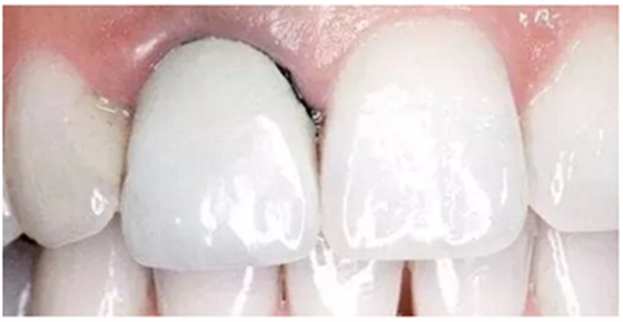 醫(yī)生，我的烤瓷牙上有個黑線怎么回事？