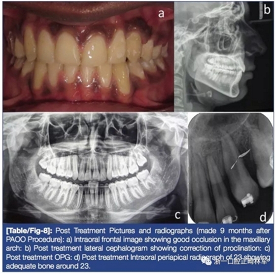 文獻(xiàn)優(yōu)秀正畸病例賞析--牙周加速成骨正畸（PAOO）輔助的腭側(cè)埋伏尖牙牽引矯治及5年跟蹤隨訪