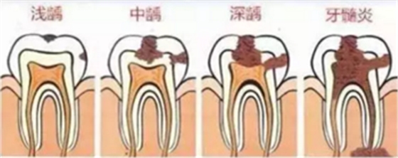 當心“腹黑”齲齒，牙齒有個小洞也要補！