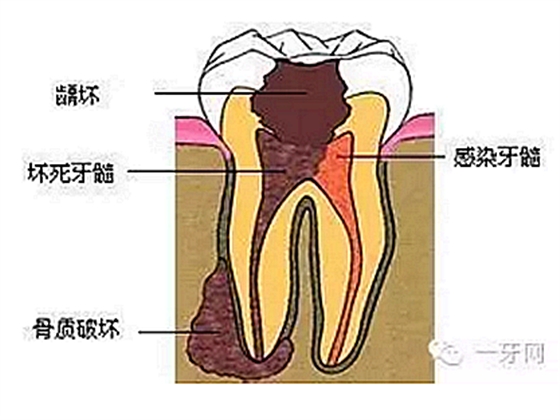 詳解牙疼的原因分幾種？