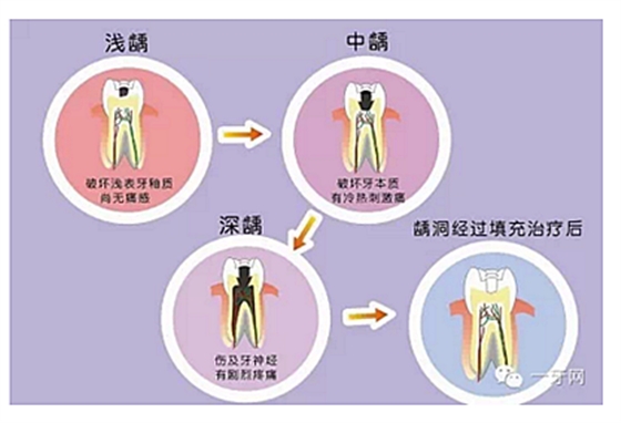 詳解牙疼的原因分幾種？