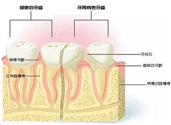 牙周病發(fā)展過(guò)程