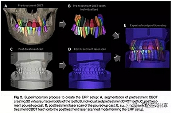 正畸文獻(xiàn)閱讀--正畸過程中牙根移動的三維監(jiān)測
