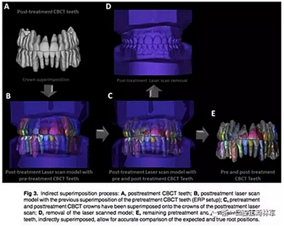 正畸文獻(xiàn)閱讀--正畸過程中牙根移動的三維監(jiān)測