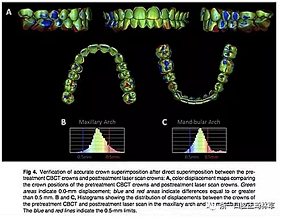 正畸文獻(xiàn)閱讀--正畸過程中牙根移動的三維監(jiān)測