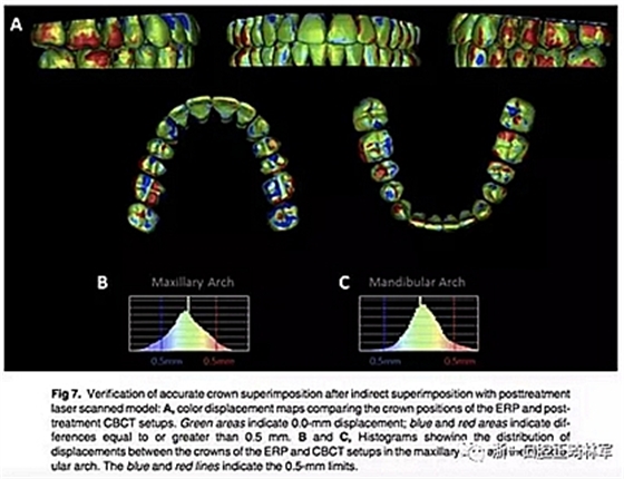 正畸文獻(xiàn)閱讀--正畸過程中牙根移動的三維監(jiān)測