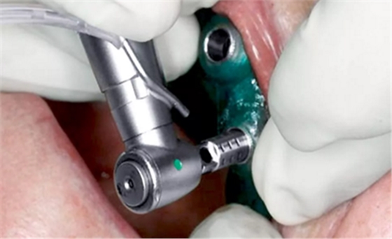 CARES?綜合的數(shù)字化解決方案---3D打印全程導(dǎo)板引導(dǎo)下植入病例一例 CARES?綜合的數(shù)字化解決方案---3D打印全程導(dǎo)板引導(dǎo)下植入病例一例