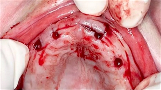 CARES?綜合的數(shù)字化解決方案---3D打印全程導(dǎo)板引導(dǎo)下植入病例一例 CARES?綜合的數(shù)字化解決方案---3D打印全程導(dǎo)板引導(dǎo)下植入病例一例