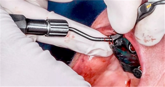 CARES?綜合的數(shù)字化解決方案---3D打印全程導(dǎo)板引導(dǎo)下植入病例一例 CARES?綜合的數(shù)字化解決方案---3D打印全程導(dǎo)板引導(dǎo)下植入病例一例