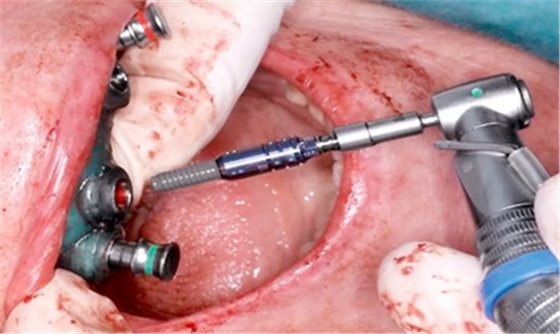 CARES?綜合的數(shù)字化解決方案---3D打印全程導(dǎo)板引導(dǎo)下植入病例一例 CARES?綜合的數(shù)字化解決方案---3D打印全程導(dǎo)板引導(dǎo)下植入病例一例