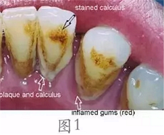 	 牙齦碰不得，一碰就出血。這是咋回事？