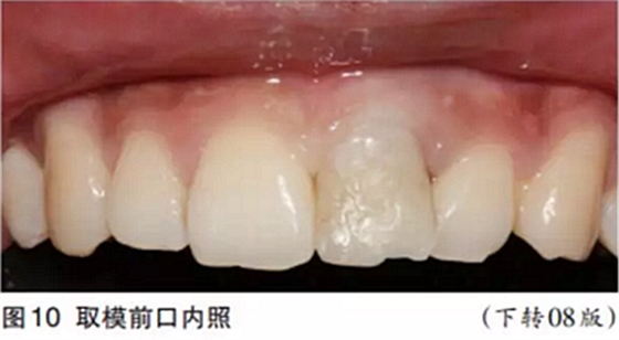 前牙即刻種植并個性化基臺美學修復