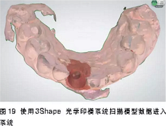 前牙即刻種植并個性化基臺美學修復