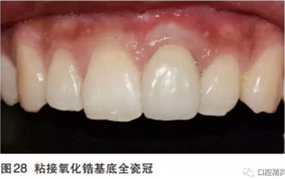 前牙即刻種植并個性化基臺美學修復